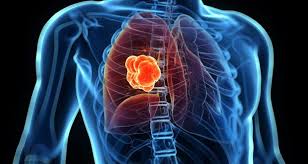 Lung Cancer